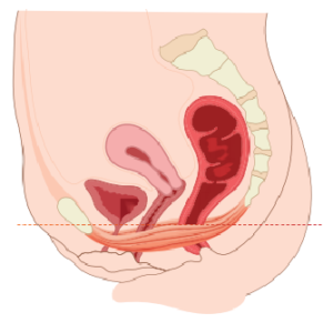 Pelvic-muscle-before-treatment