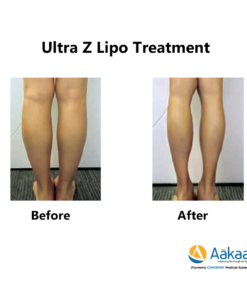 Z-lipo-HI-Definition-Liposuction