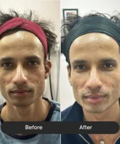 before after etreluxe Nucleotide