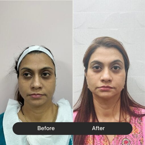 before after etreluxe Nucleotide