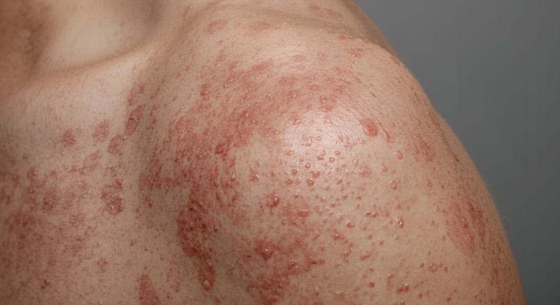 Anti-inflammatory Diet for Psoriasis